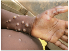 Mpox Cases Reach 1,298 as Kenya Records 19 Deaths