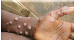 Mpox Cases Reach 1,298 as Kenya Records 19 Deaths
