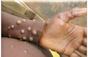 Mpox Cases Reach 1,298 as Kenya Records 19 Deaths
