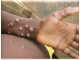 Mpox Cases Reach 1,298 as Kenya Records 19 Deaths