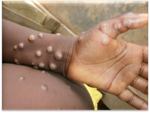 Mpox Cases Reach 1,298 as Kenya Records 19 Deaths